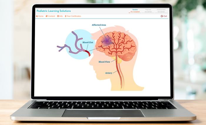 Pediatric Stroke Overview
